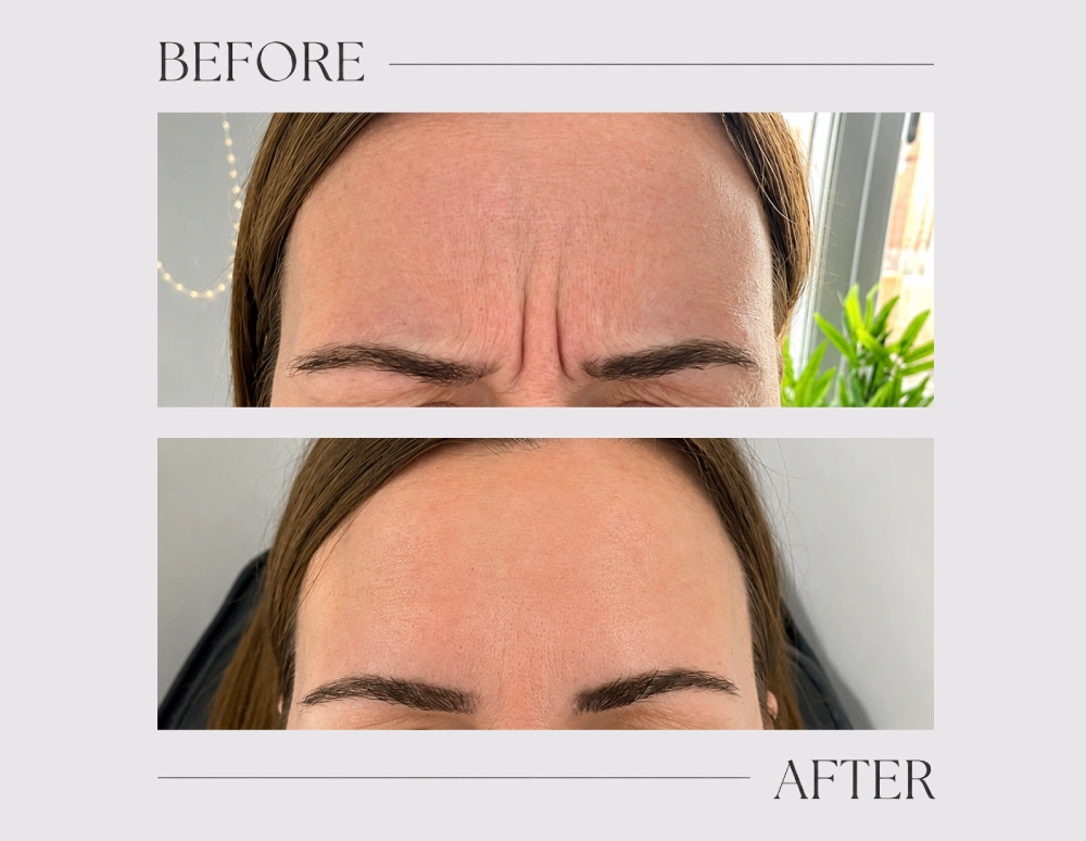 Anti wrinkle treatment (1 area)