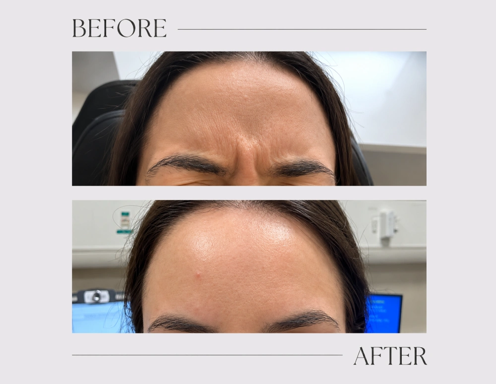 Anti wrinkle treatment (1 area)