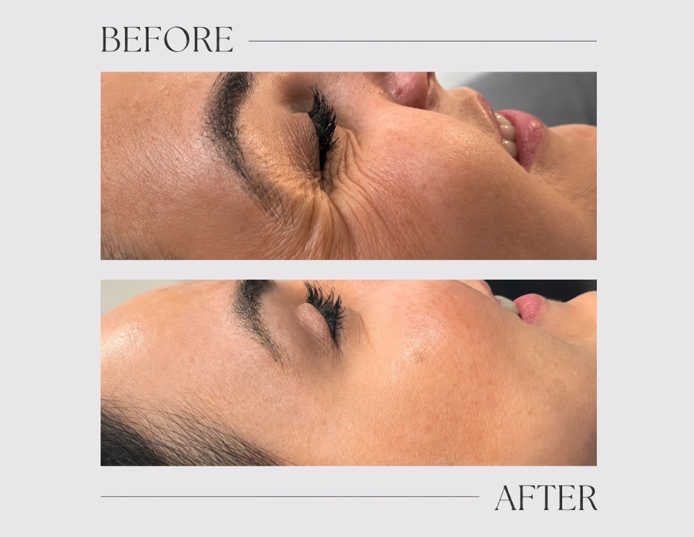 Anti wrinkle treatment (1 area)