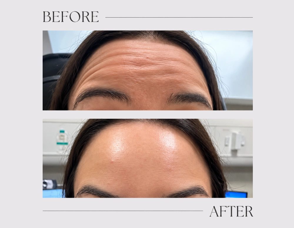 Anti wrinkle treatment (2 areas)