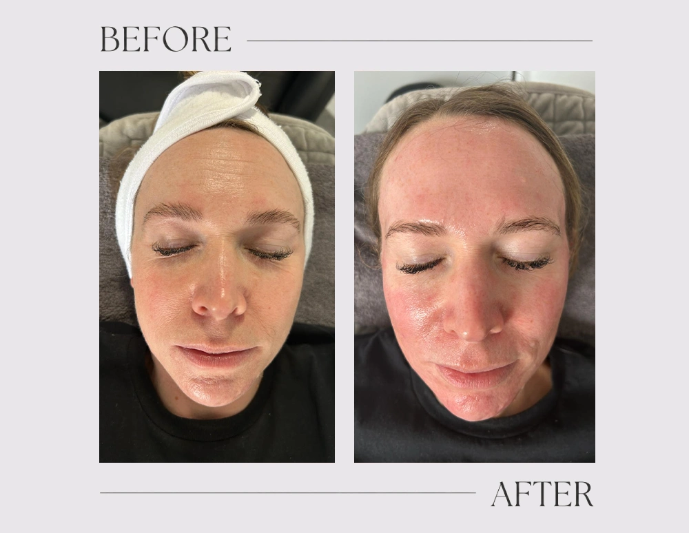 Microneedling Dermaplaning Facials